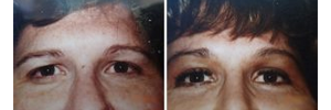 Browlift (before & after)